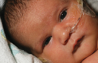 A baby with a feeding tube